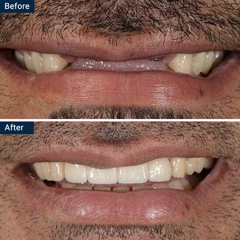 Dental Implant Bridge 1