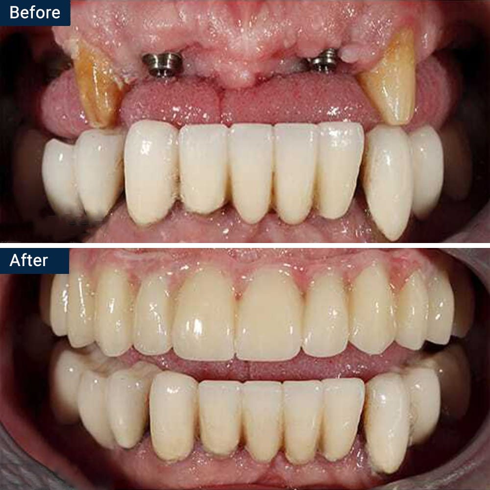 Dental Implant Bridge
