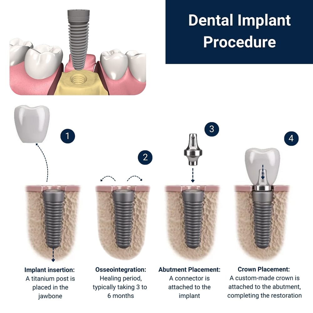 Dental Implant Procedure in Brooklyn