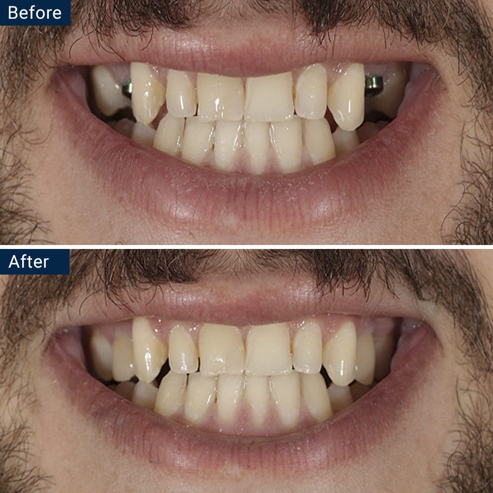 Dental Implants Before and After