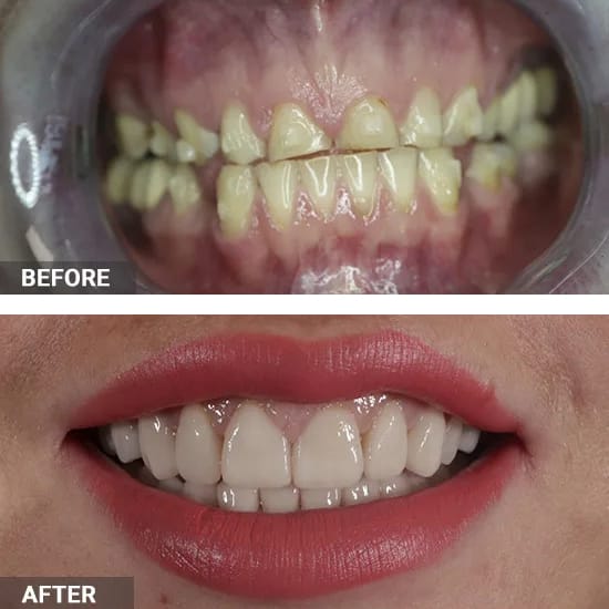 Upper Crowns Veneers Full Mouth Rehab Before and After
