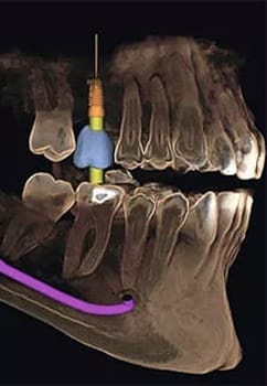 3-D imaging system for dental implants