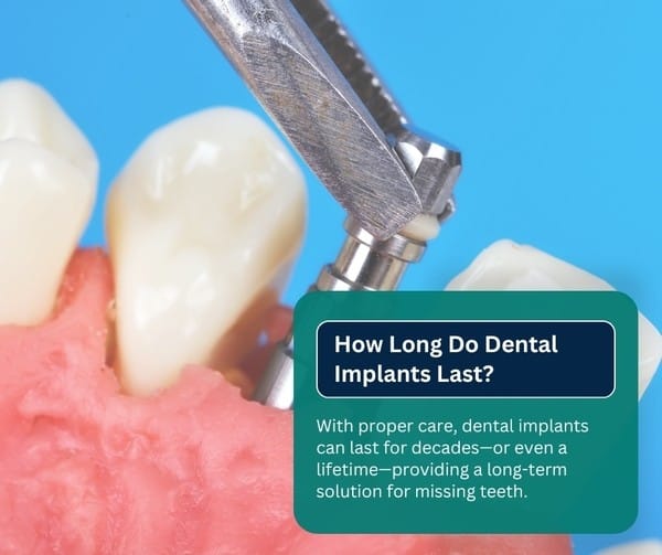 How Long Do Dental Implants Last