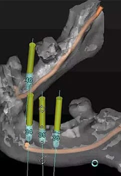 planning software for dental implants