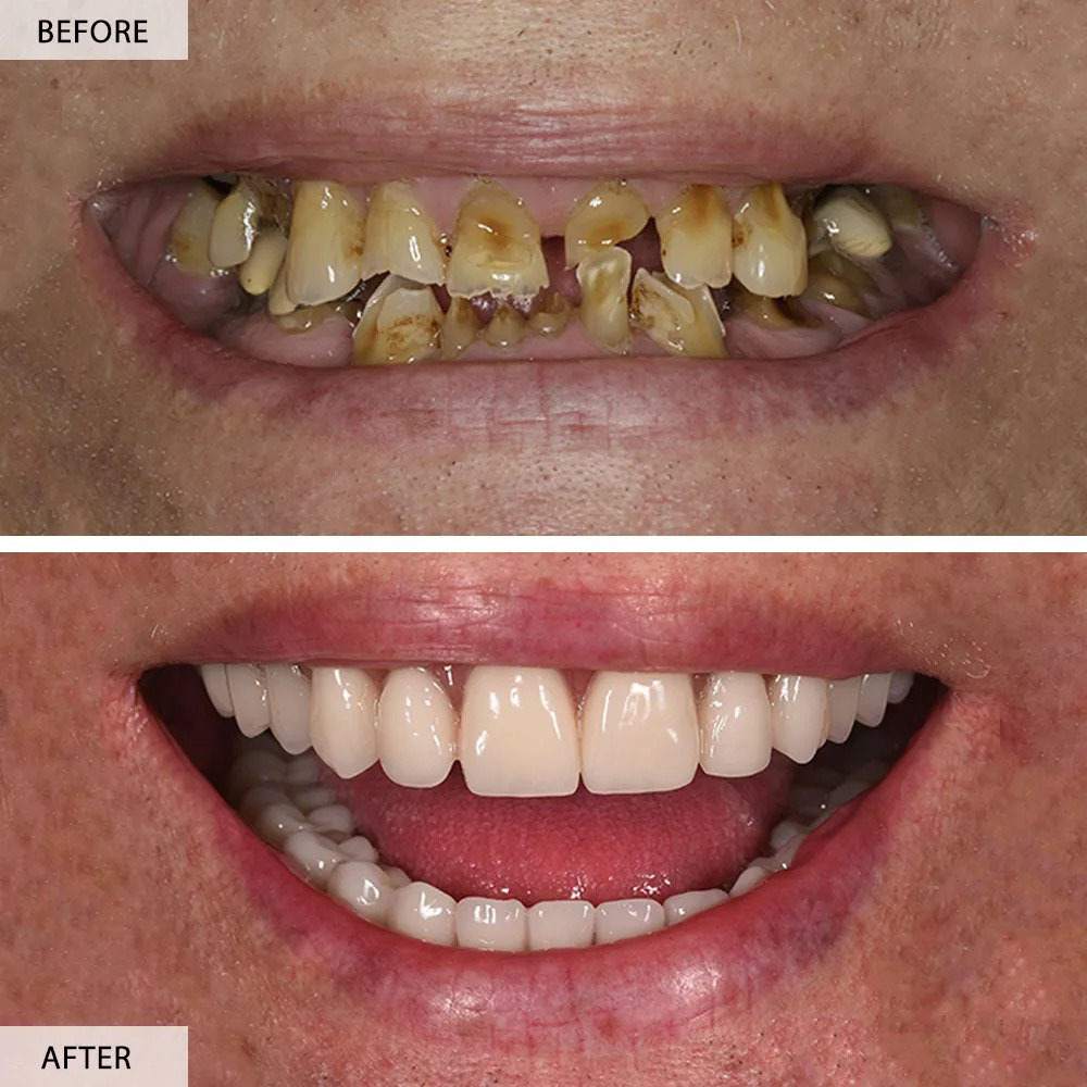 Zygomatic Dental Implants Before and After