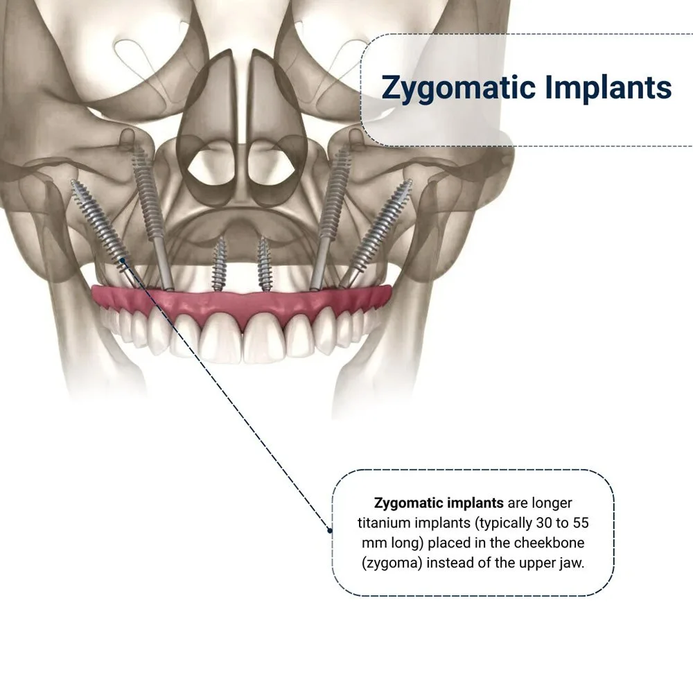 Zygomatic Dental Implants in Brooklyn
