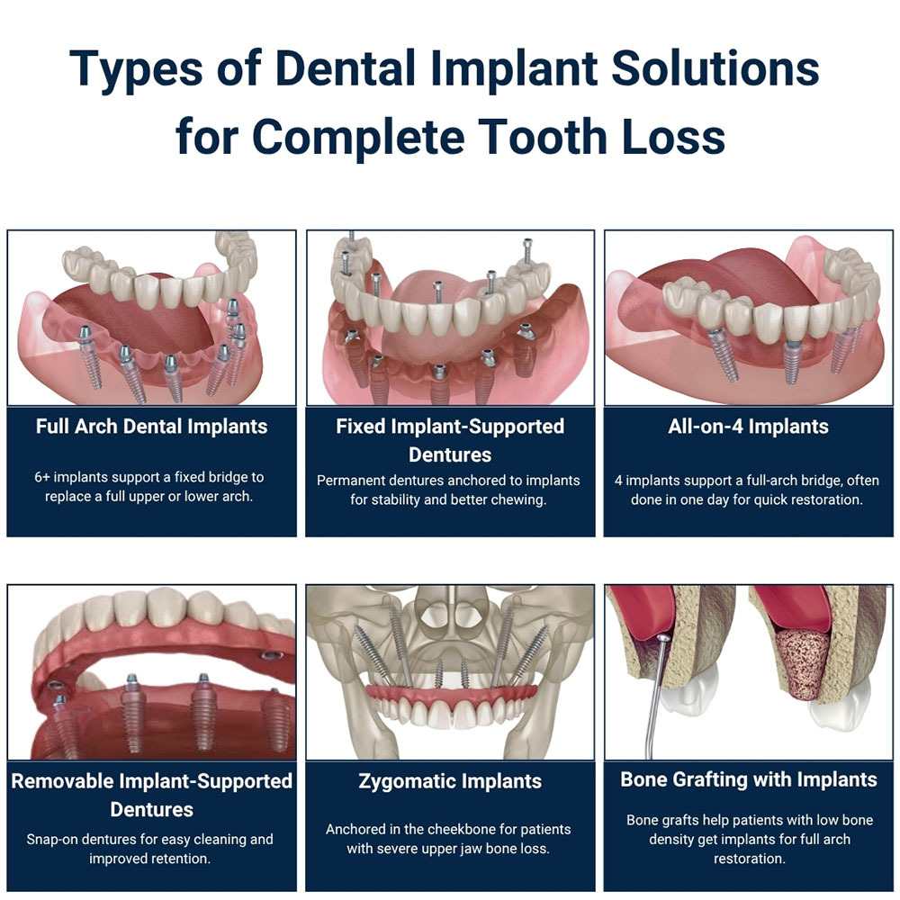 Types of Dental Implant Solutions For Complete Tooth Loss