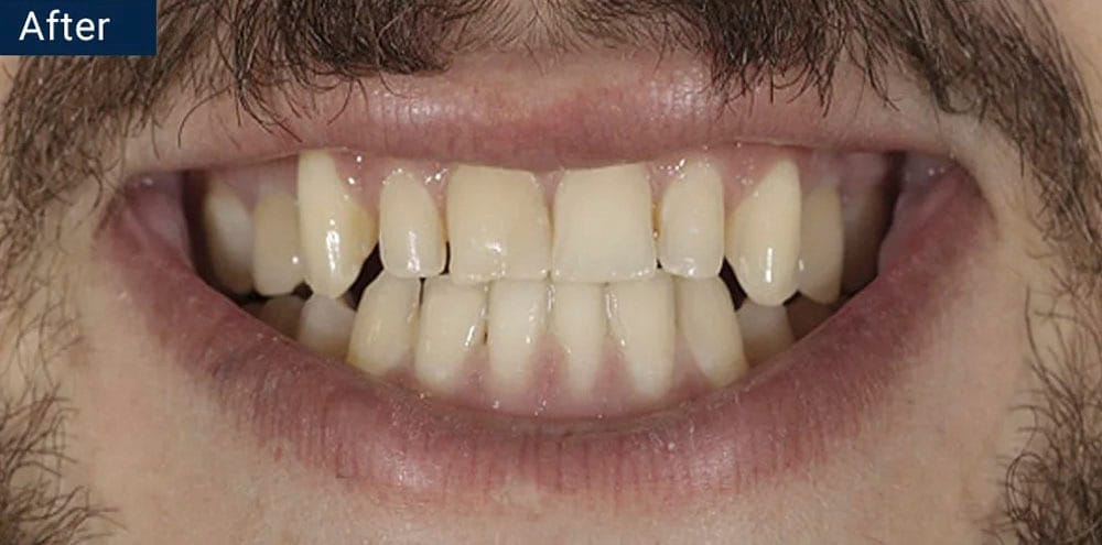 Dental Implants After