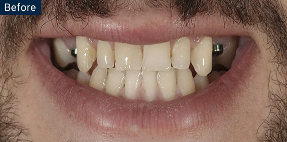 Dental Implants Before