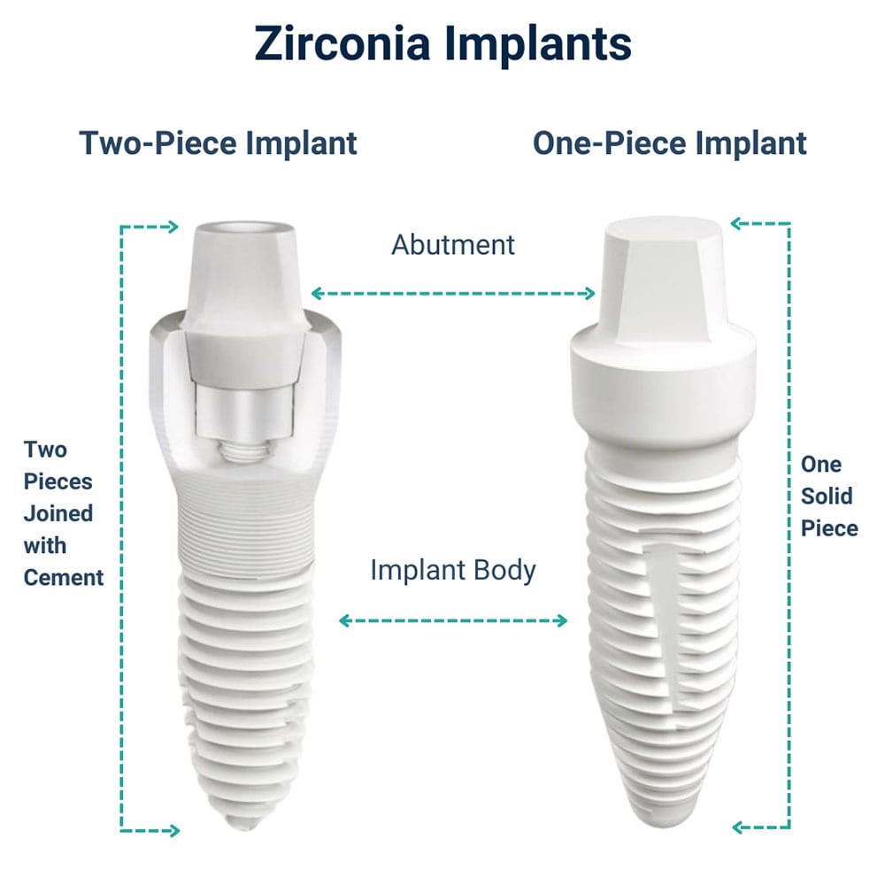 Zirconia Dental Implants in Brooklyn NY