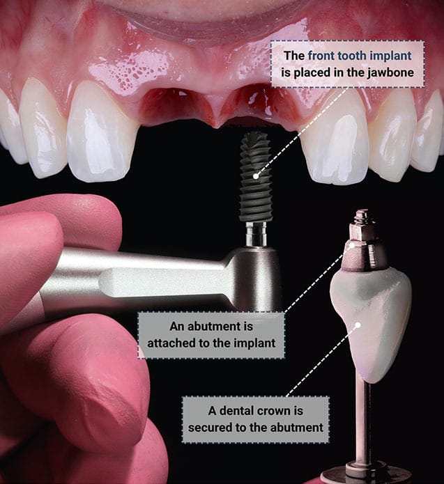 Front Tooth Dental Implant Procedure in Brooklyn