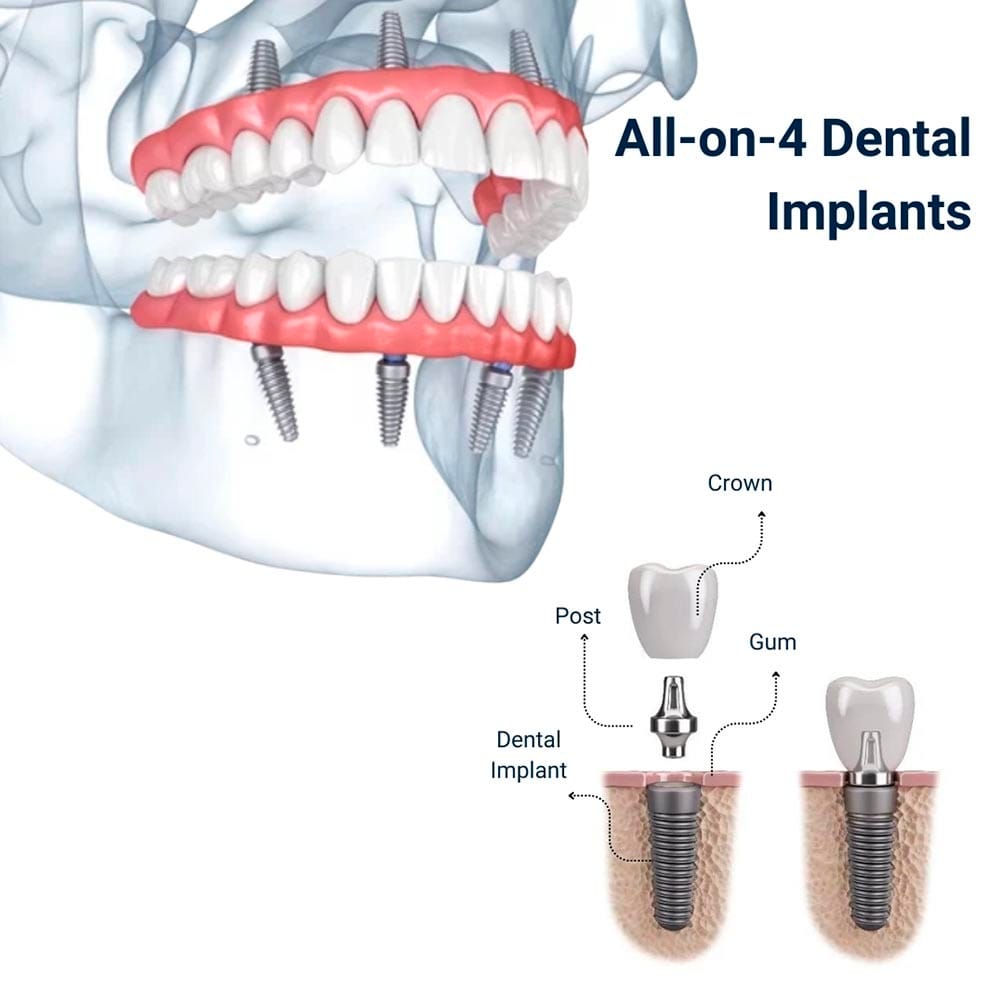 All-on-4 Dental Implants in Brooklyn