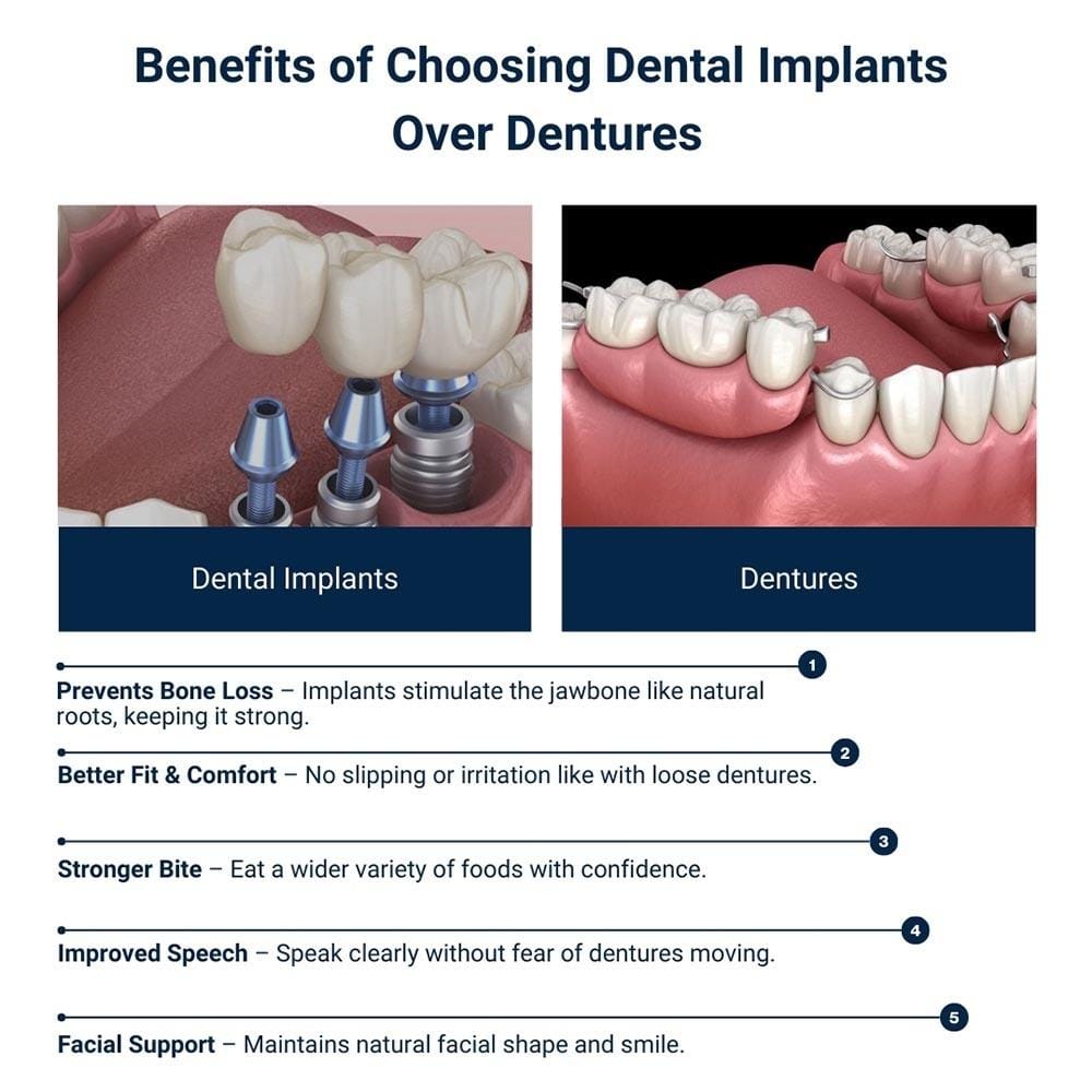 Benefits of Choosing Dental Implants Over Dentures