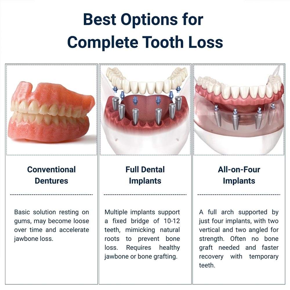 Best Options for Complete Tooth Loss in Brooklyn