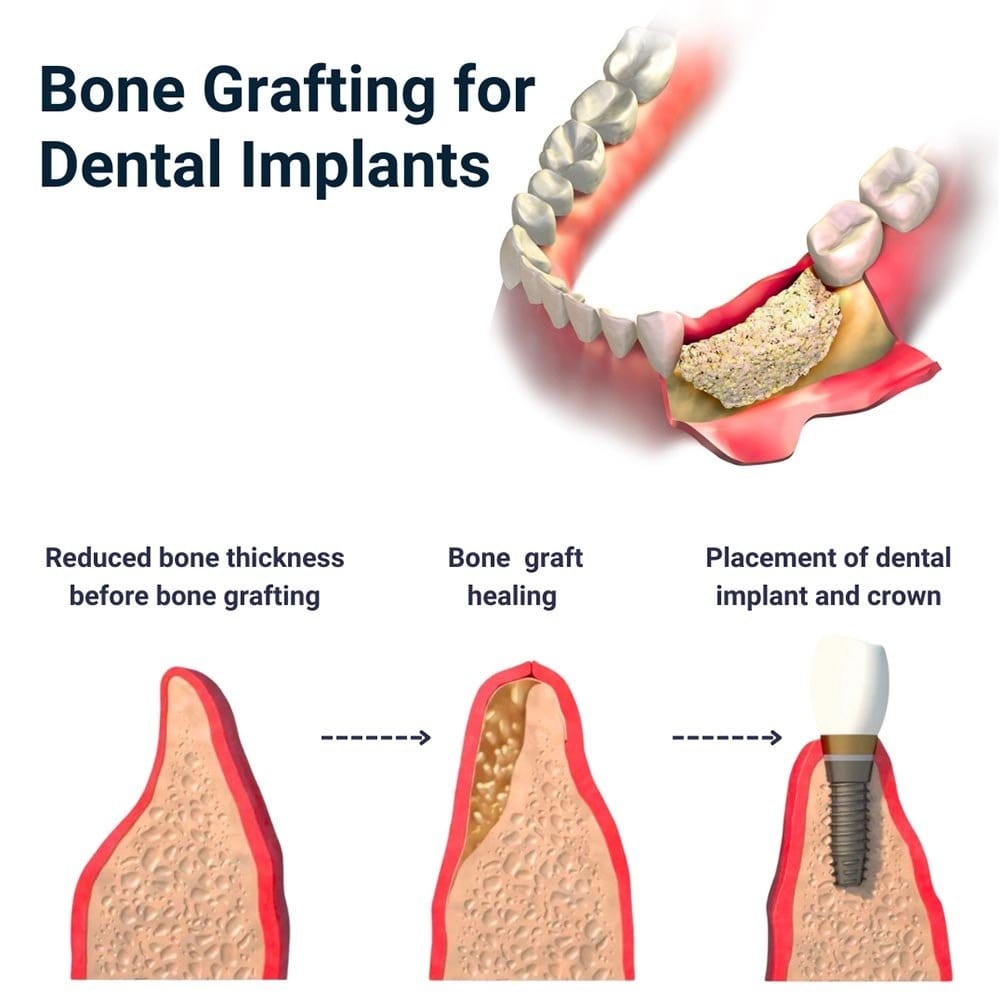 Bone Grafting For Dental Implants in Brooklyn