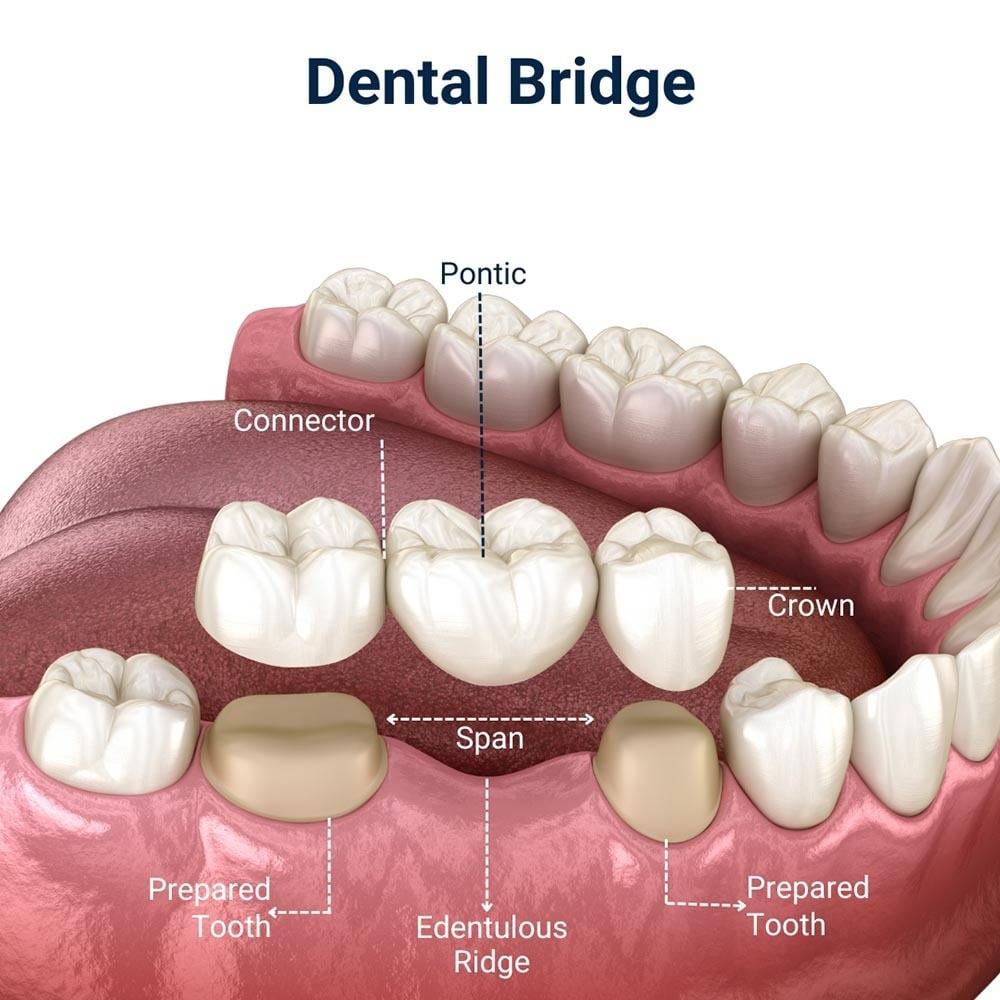 Dental Bridge in Brooklyn