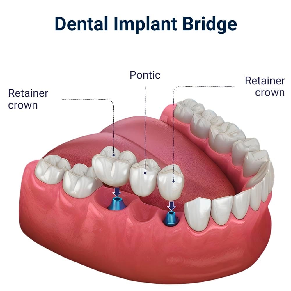 Dental Implant Bridge in Brooklyn