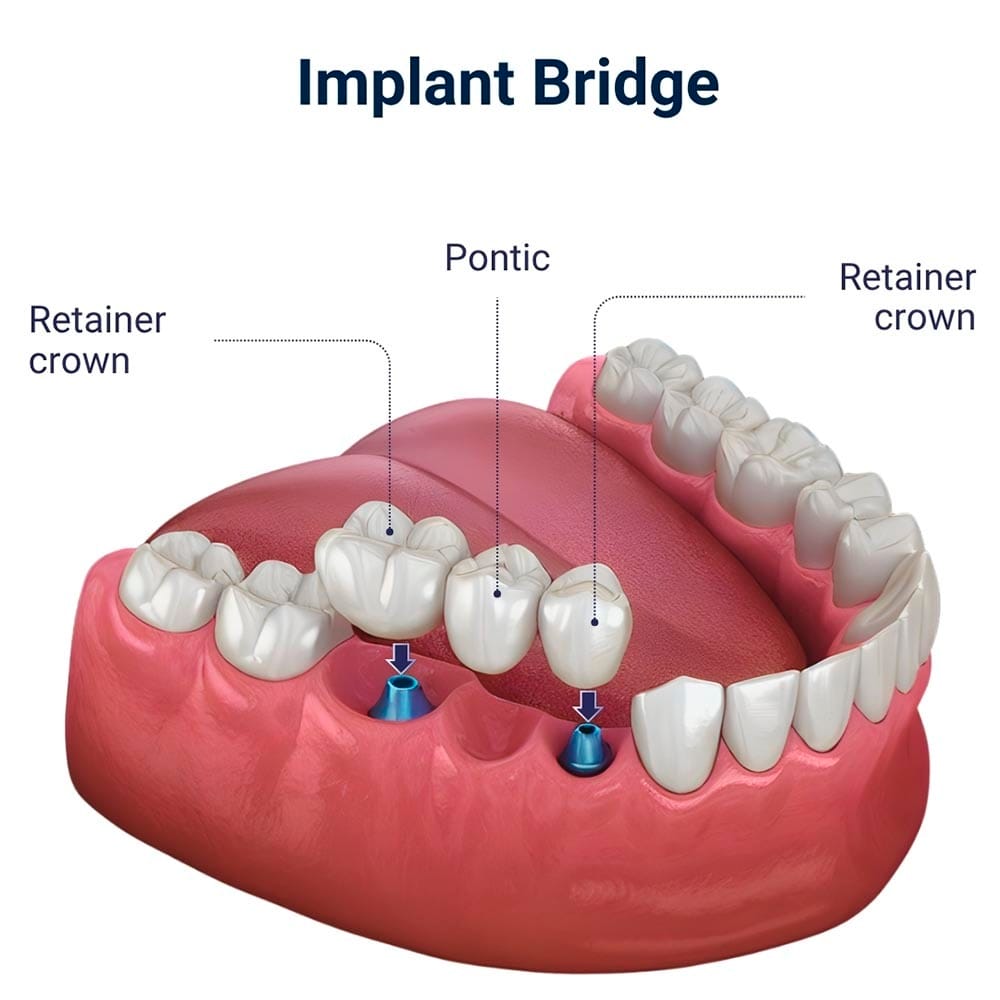 Implant Bridge in Brooklyn