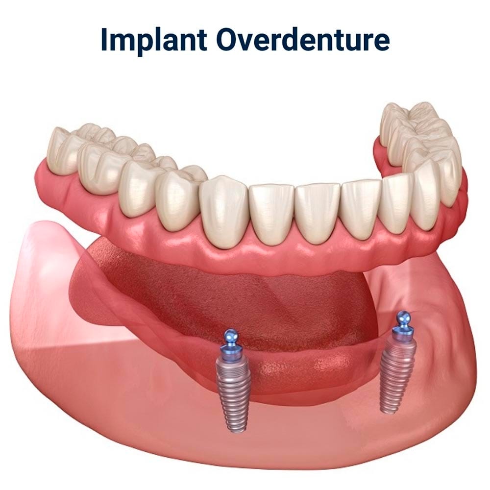 Implant Overdenture in Brooklyn