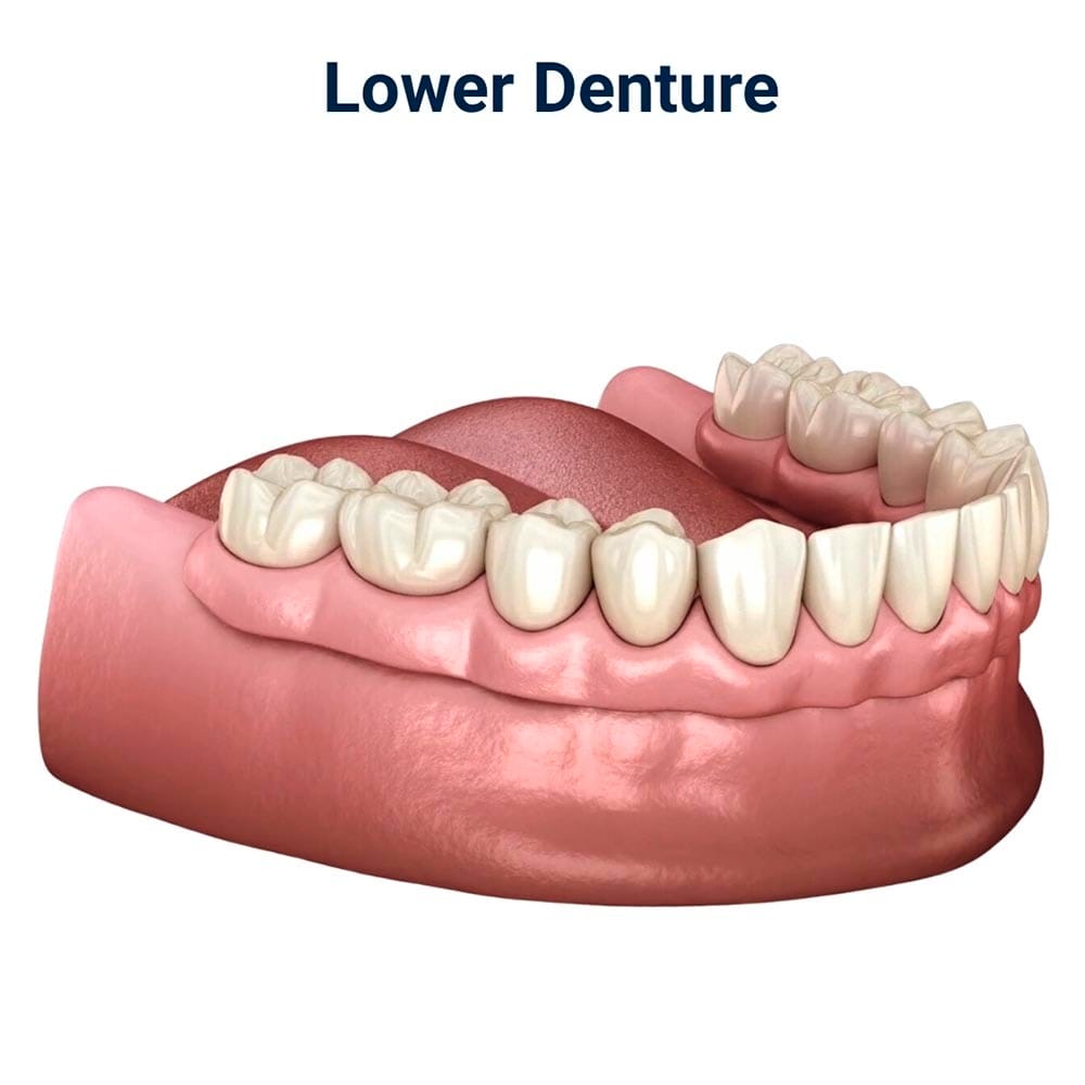 Lower Denture in Brooklyn