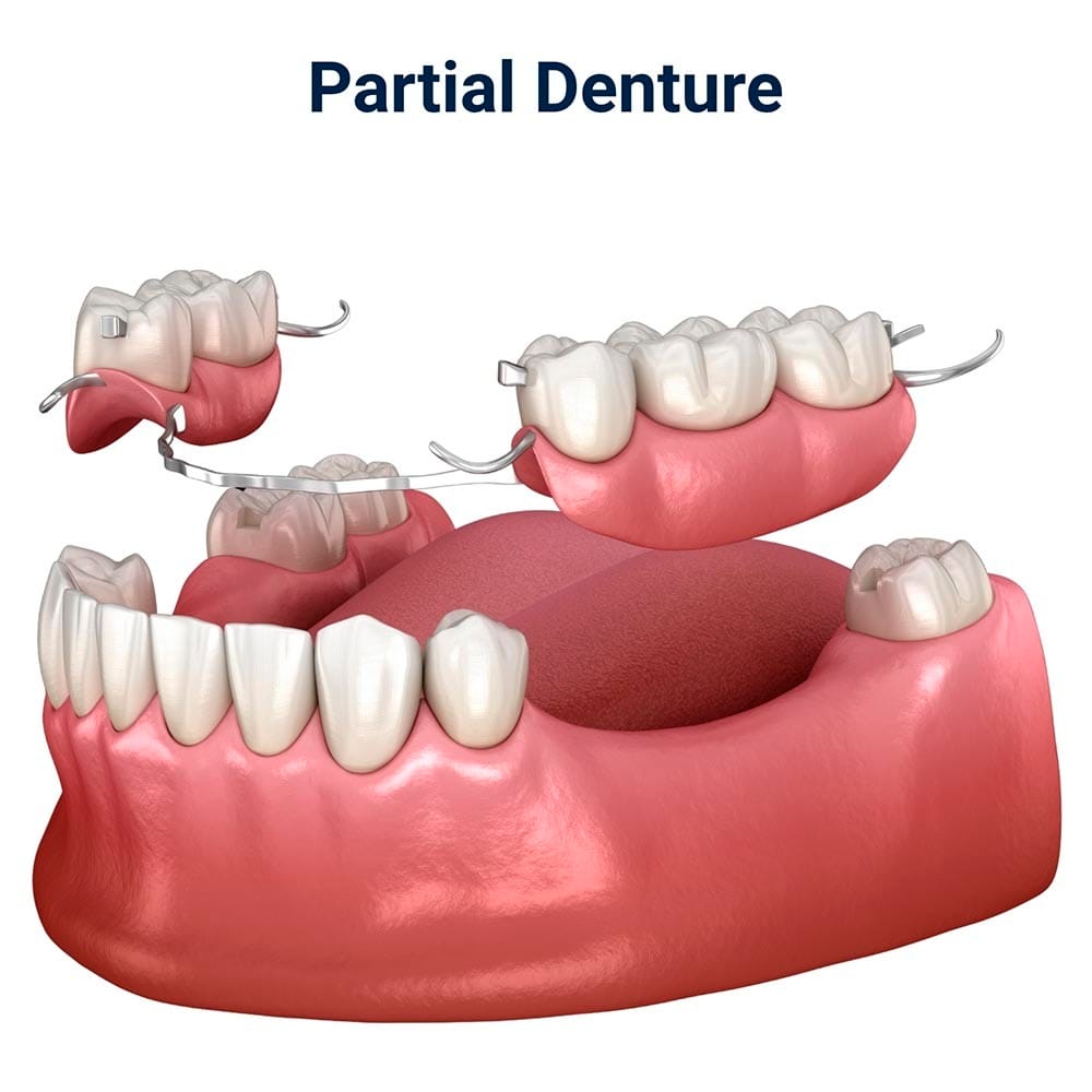 Partial Denture in Brooklyn