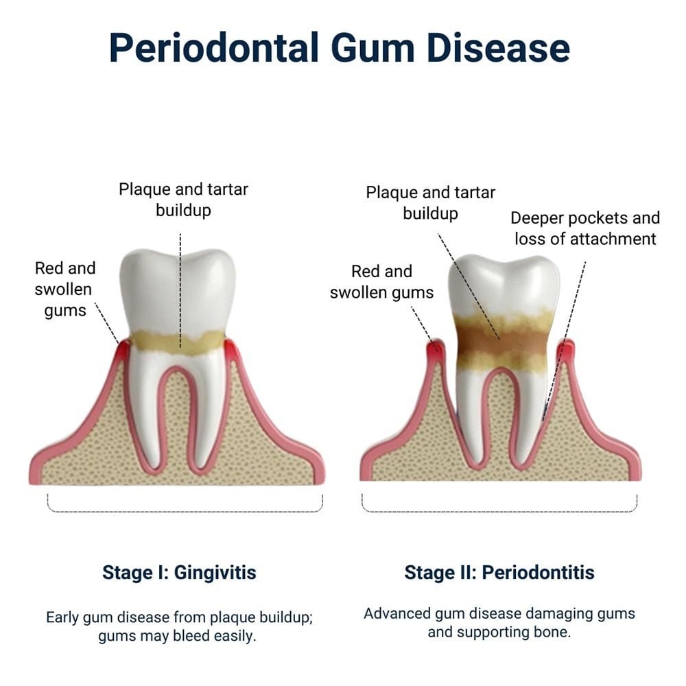 Periodontal Gum Disease