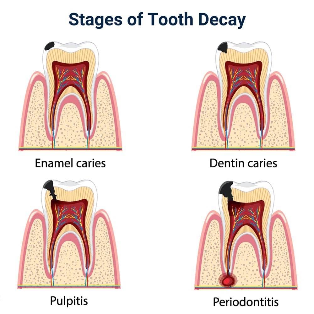 Stages of Tooth Decay