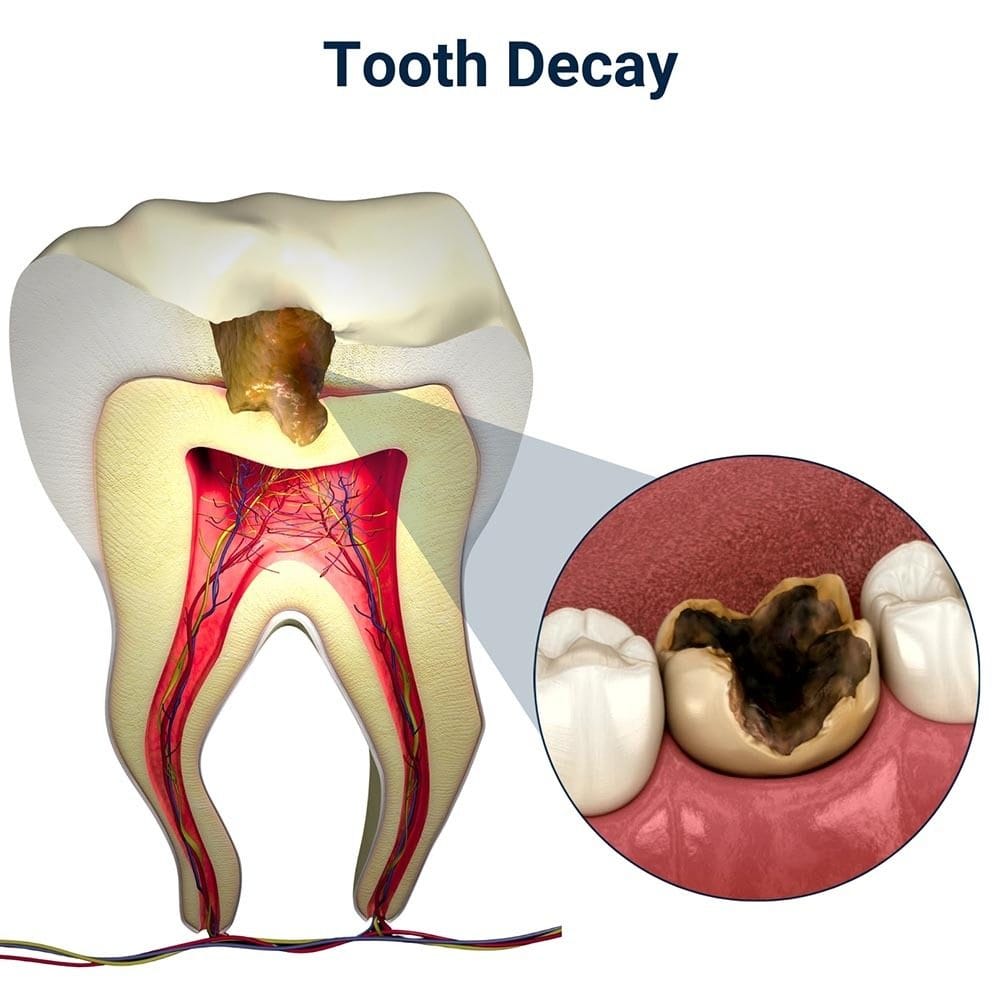 Tooth Decay Treatment in Brooklyn