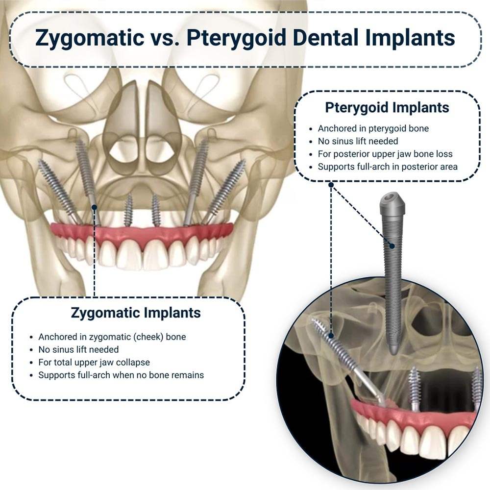 Zygomatic vs Pterygoid Dental Implants in Brooklyn
