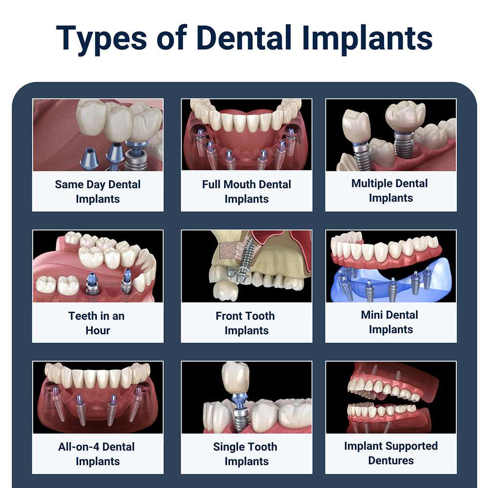 Types of Dental Implants Brooklyn